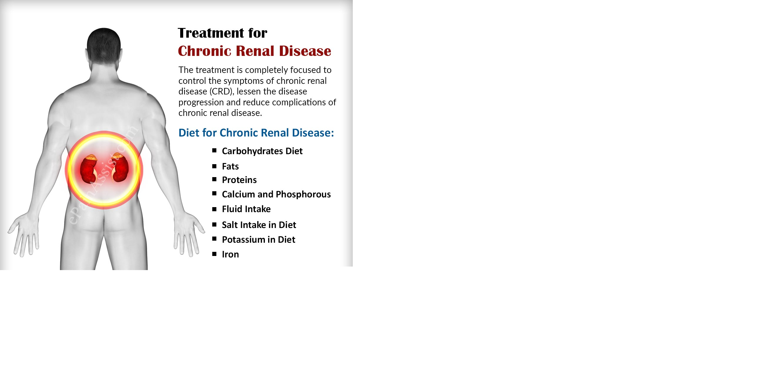 Почечная недостаточность симптомы у женщин лечение. Chronic renal failure Palpation Percussion. Modified Diet in renal disease study. The Symptoms of chronic renal failure pics.